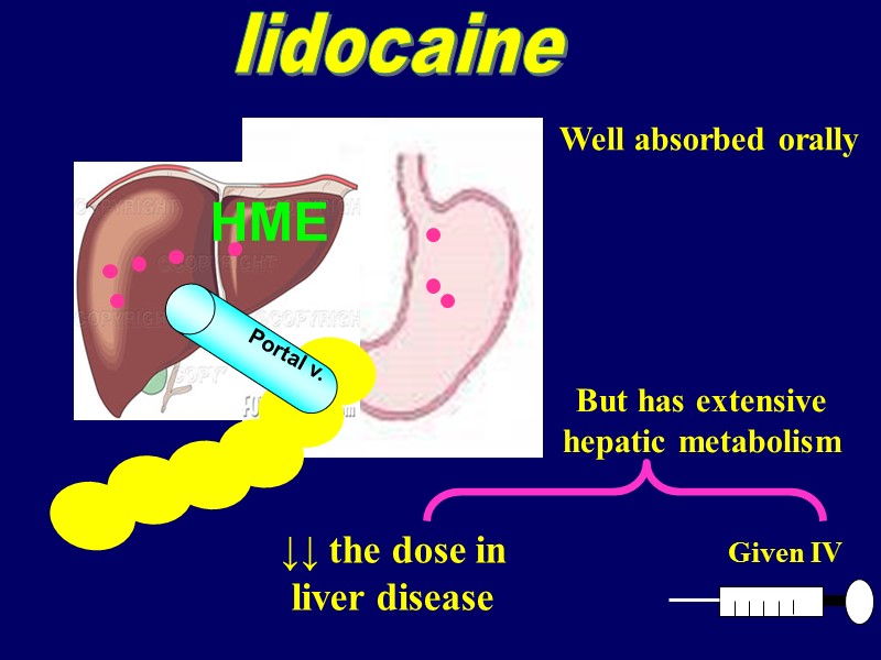 Portal v. HME lidocaine Well absorbed orally But has extensive hepatic metabolism Given IV